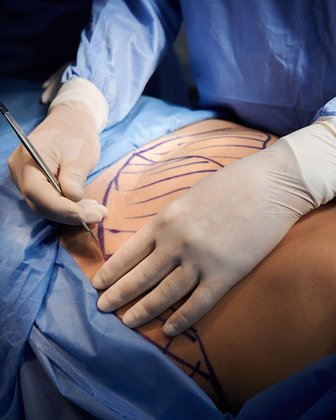 Image of LIPOESCULTURA