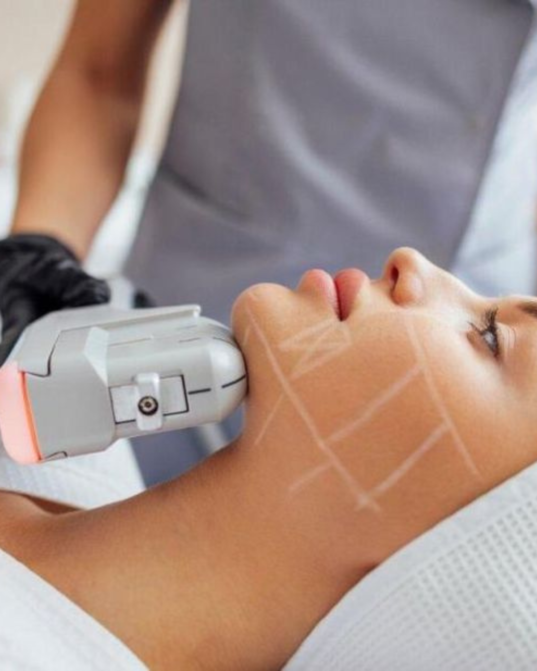 HIFU 12D ULTRA MATRIX ROSTRO