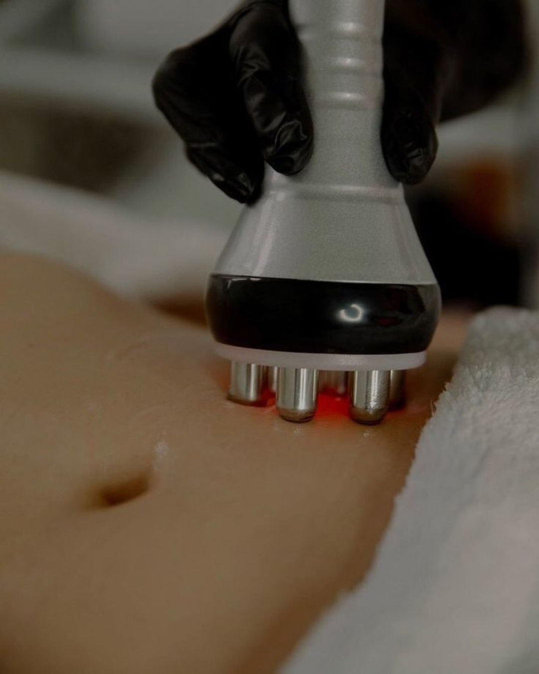 RADIOFRECUENCIA CORPORAL